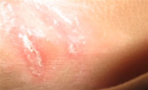 Intertrigo – Pictures, Rash, Symptoms, Causes, Treatment | HubPages