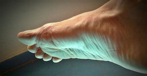 Psoriatic Arthritis in the Feet: Symptoms and Treatment | MyPsoriasisTeam