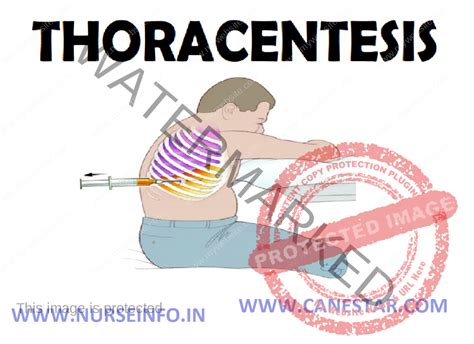 THORACENTESIS - Nurse Info