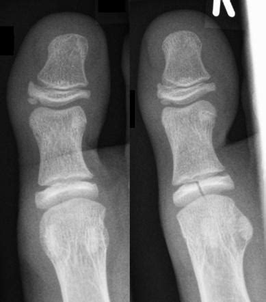 Cleft epiphysis | Radiology Reference Article | Radiopaedia.org