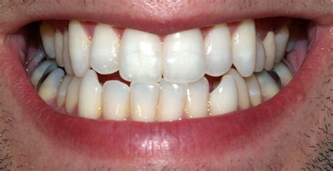 File:Teeth by David Shankbone.jpg - Wikipedia