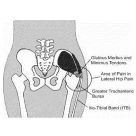 Greater Trochanteric Pain Syndrome (GTPS) - msk