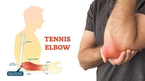 Tennis Elbow Symptoms, Treatment, and Prevention Tips… | Tristate Arthritis & Rheumatology