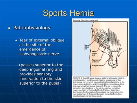 Sports Hernia : Athletic Pubalgia - Sports Hernia 1 - YouTube / Again, a sports hernia isn't a ...