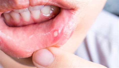 5 Remedies To Help You Get Rid of Canker Sores - lifeberrys.com