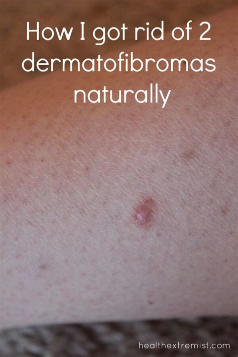 How to Get Rid of a Dermatofibroma Naturally Skin Bumps, Itchy Bumps ...