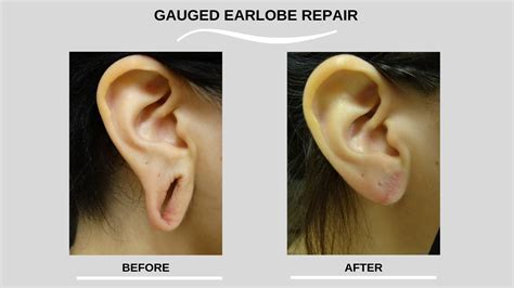 What It's Like Getting Earlobe Repair Surgery, Ear Hole Repair Without ...