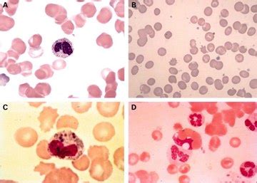 » Urosepsis – Treatment, Pathophysiology, Symptoms, Causes, Diagnosis