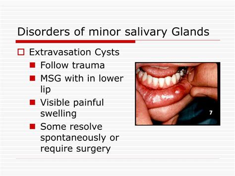 PPT - Salivary Glands Disorders PowerPoint Presentation, free download - ID:734033