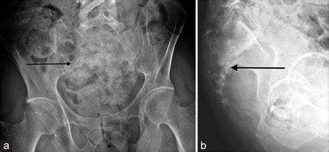 Sacrum Xray