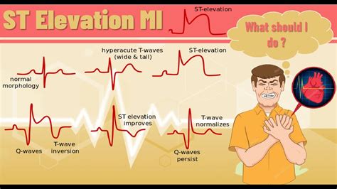 ST elevation myocardial infarction -STEMI | ST elevation MI pathophysiology, ECG finding and ...