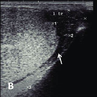 Ultrasound image of pampiniform plexus. (A) Right pampiniform plexus... | Download Scientific ...