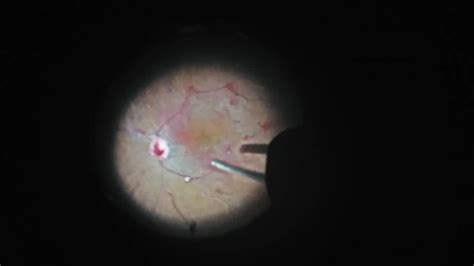 Vitrectomy for Severe Diabetic Retinopathy and Vitreous Hemorrhage ...