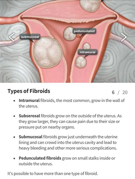 In Case You Missed: Uterine Fibroids