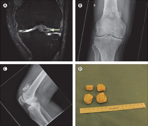 Pain, popping, and episodic locking of the knee: osteochondromatosis - The Lancet