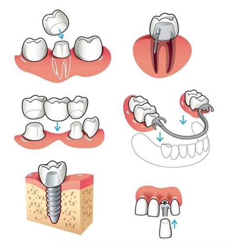 105 best Fixed Prosthodontics images on Pinterest | Bridge, Bridge ...