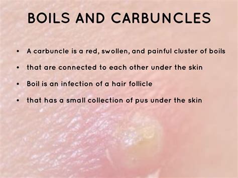 Boil on neck causes: Carbuncle – Mayo Clinic