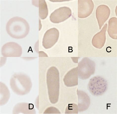 Thalassemia Blood Smear Abnormal Red Blood Cells Morphology Medical | The Best Porn Website