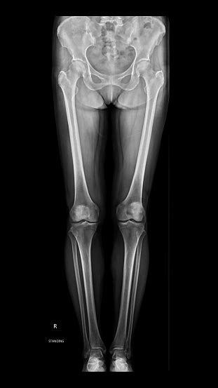 Xray Of Total Lower Extremity Stock Photo - Download Image Now - X-ray Image, Leg, Ankle - iStock