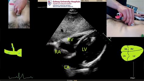 1/10 Echo Tweetorial 4 - SUBCOSTAL VIEW 1. The subcostal view 2. IVC 3 ...