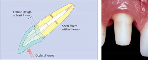 37 Adhesive-retained, Fiber-reinforced Composite Posts | Pocket Dentistry