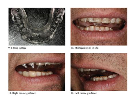 TMD's And Occlusal Splint Therapy PPT, 57% OFF