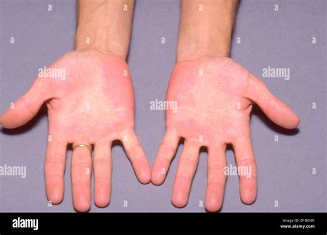 PALMAR ERYTHEMA Stock Photo - Alamy