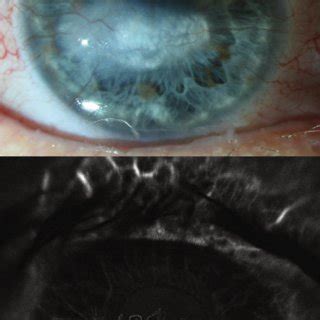 Colour photograph showing corneal neovascularisation with associated ...