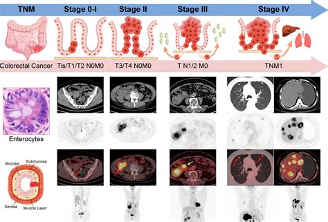 Frontiers | Tailoring the clinical management of colorectal cancer by ...