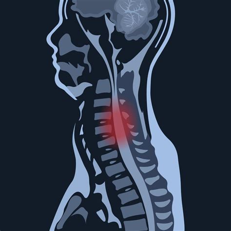 MRI of the cervical spine with and without contrast, MRI with bilateral C7 root compression ...