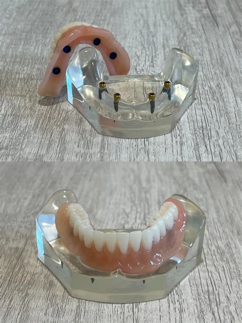 Snap-In Implant Dentures | Woodside Dental Group