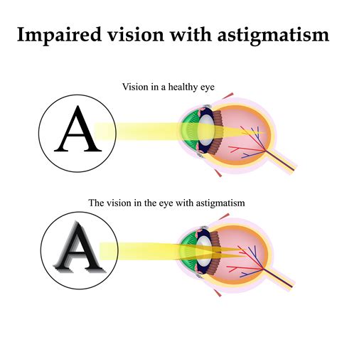 I’ve Got Astigmatism, Can I Get LASIK? - Vision First