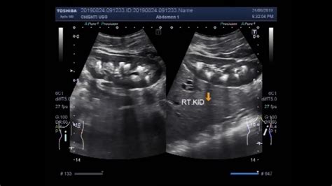 Ultrasound Video showing bilateral Medullary nephrocalcinosis and renal calculi. - YouTube