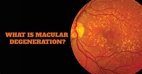 Macular Degeneration, Causes Symptoms and its 2 Types | Marham