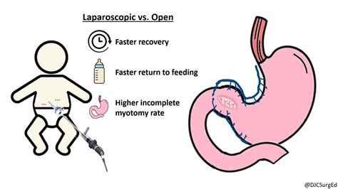 Hypertrophic Pyloric Stenosis - YouTube