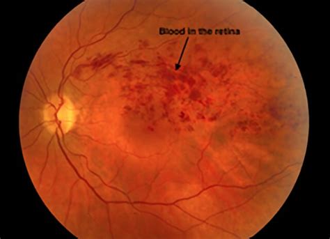 Branch Vein Occlusion Treatment | Retinal Consultants Medical Group