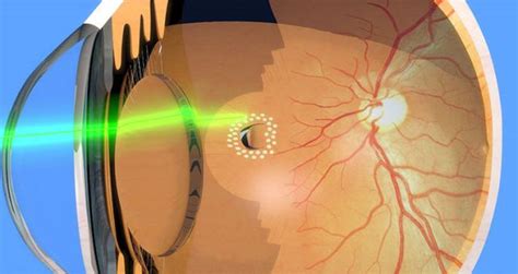 Epiretinal Membrane Symptoms, Causes, and Treatment