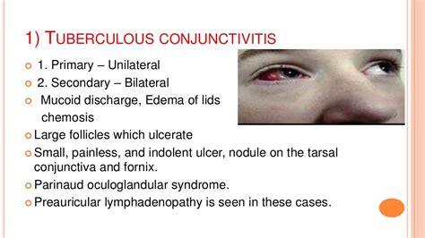 Ocular manifestations of tuberculosis infection