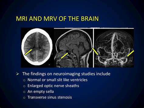 Idiopathic intracranial hypertension