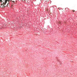 Re fl ection of the duodenal tumour through the duodenotomy. | Download Scientific Diagram