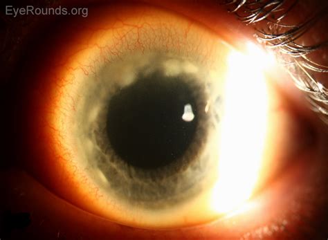 Corneal Marginal Ulcer