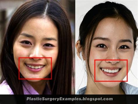 Plastic Surgery Examples: Kim Tae Hee plastic surgery before & after ...