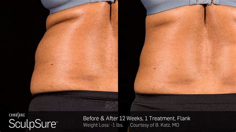 Sculpsure - View Images Before And After Treatment