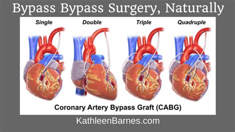 Bypassing bypass surgery, naturally - KathleenBarnes.com