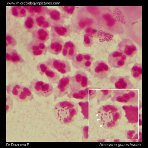 Gonococcus (Neisseria gonorrhoeae) Gram-stain and cell morphology. A ...