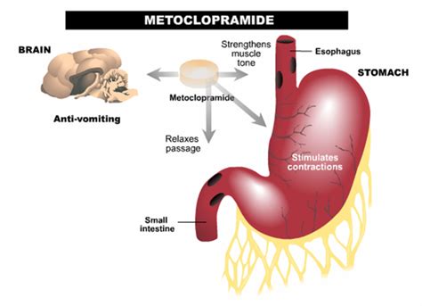 Metoclopramide - Stepwards