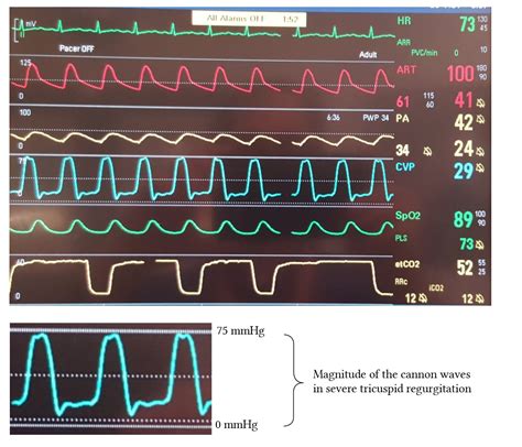 Abnormal central venous pressure waveform patterns | Deranged Physiology