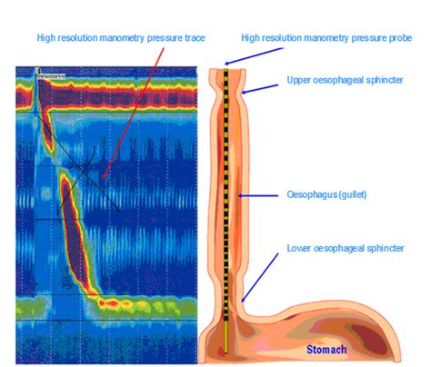 Esophageal Manometry