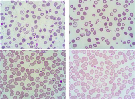 Peripheral Blood Smears Image of Thalassemia Patients. | Download ...