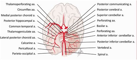 Posterior Inferior Cerebellar Artery Stroke